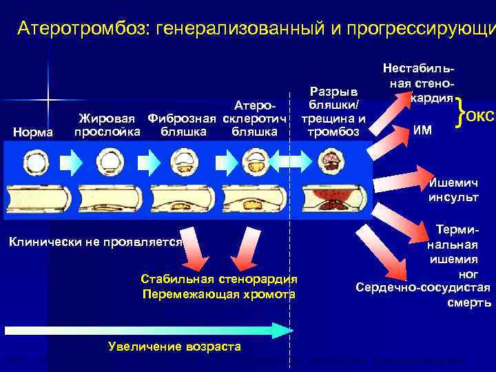 Атеротромбоз: генерализованный и прогрессирующи Норма Атеро. Жировая Фиброзная склеротич бляшка прослойка бляшка Разрыв бляшки/