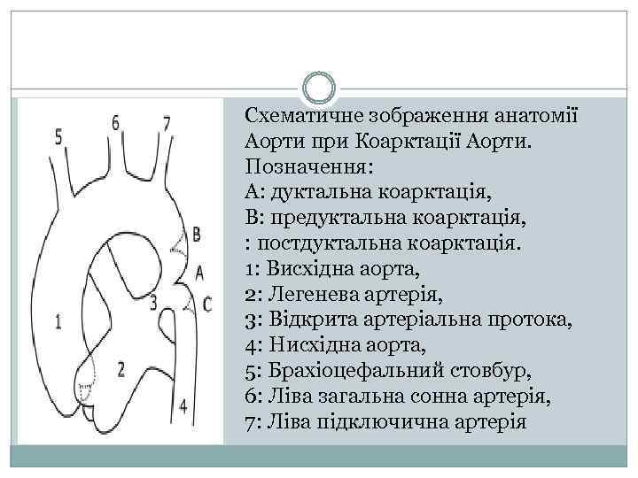 Схематичне зображення анатомії Аорти при Коарктації Аорти. Позначення: A: дуктальна коарктація, B: предуктальна коарктація,