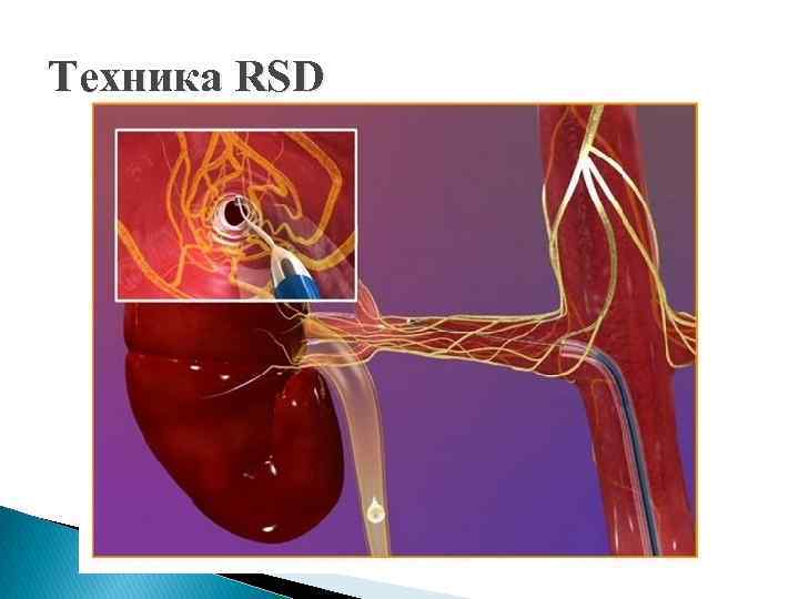 Техника RSD 