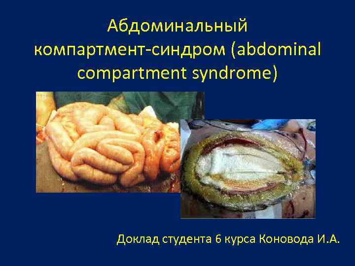 Абдоминальный компартмент-синдром (abdominal compartment syndrome) Доклад студента 6 курса Коновода И. А. 