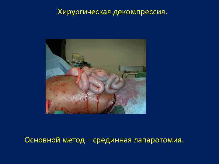 Хирургическая декомпрессия. Основной метод – срединная лапаротомия. 