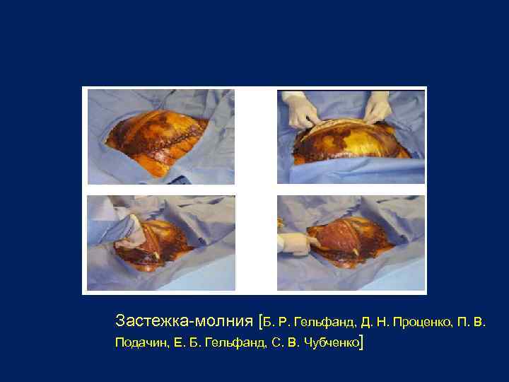 Застежка-молния [Б. Р. Гельфанд, Д. Н. Проценко, П. В. Подачин, Е. Б. Гельфанд, С.