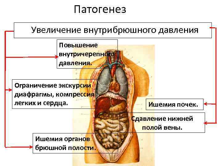 Патогенез Увеличение внутрибрюшного давления Повышение внутричерепного давления. Ограничение экскурсии диафрагмы, компрессия легких и сердца.