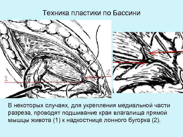 Пластика при прямых паховых грыжах