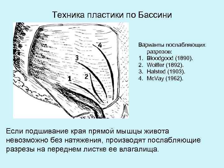 Схемы пластики пахового канала