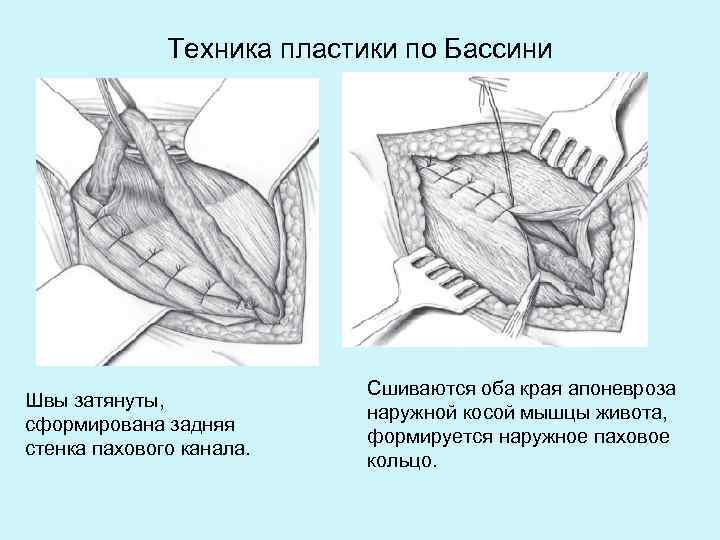 Пластика по бассини при паховой грыже