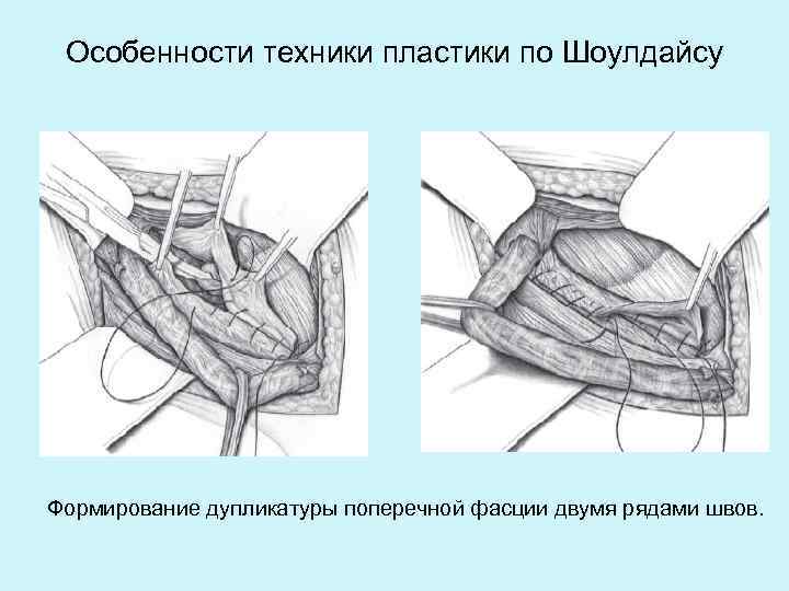 Особенности техники пластики по Шоулдайсу Формирование дупликатуры поперечной фасции двумя рядами швов. 