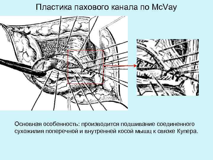 Пластика при прямых паховых грыжах