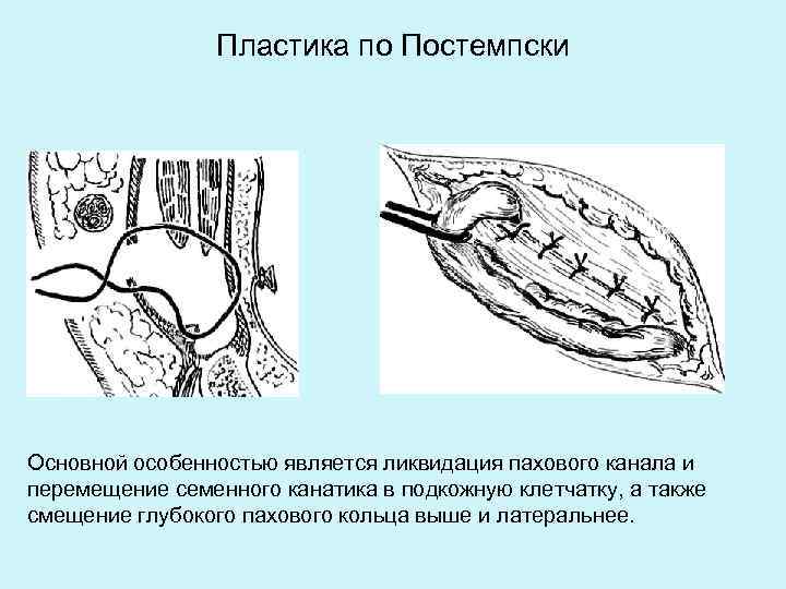 Схемы пластики пахового канала