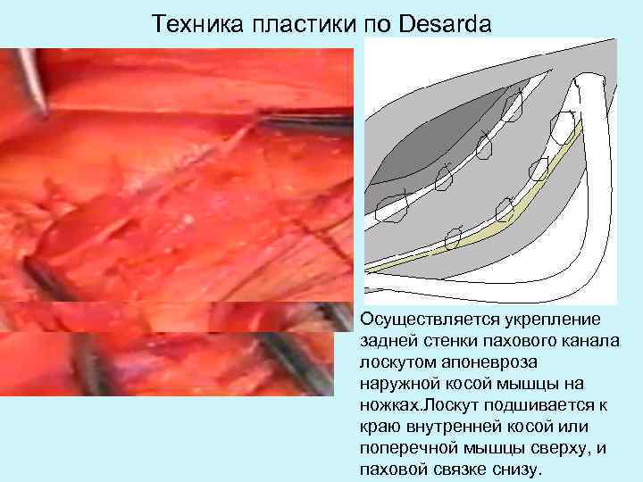Техника пластики по Desarda Осуществляется укрепление задней стенки пахового канала лоскутом апоневроза наружной косой