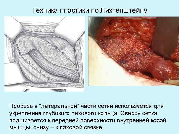 Техника пластики по Лихтенштейну Прорезь в “латеральной” части сетки используется для укрепления глубокого пахового