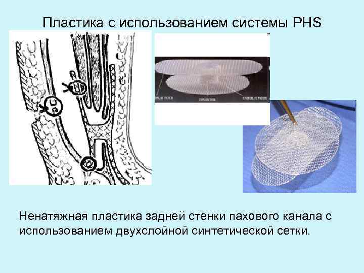 Пластика с использованием системы PHS Ненатяжная пластика задней стенки пахового канала с использованием двухслойной