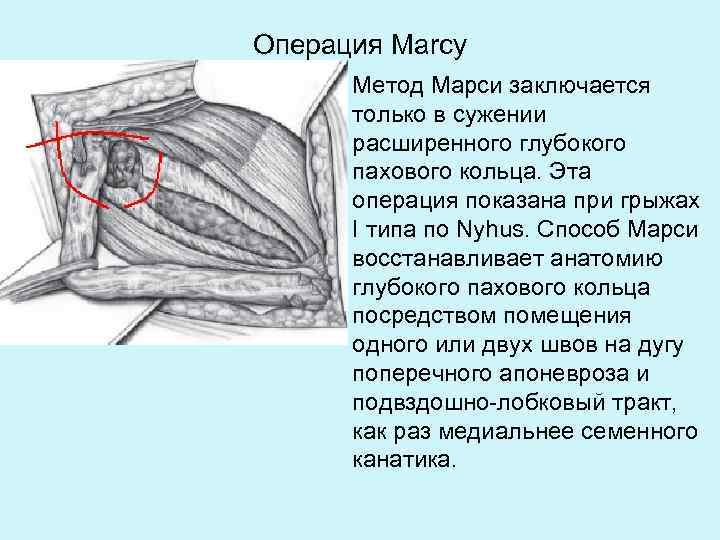 Паховые кольца у футболистов. Глубокое паховое кольцо анатомия. Способы пластики пахового канала.