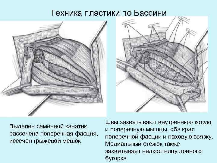 Пластика по краснобаеву пахового канала