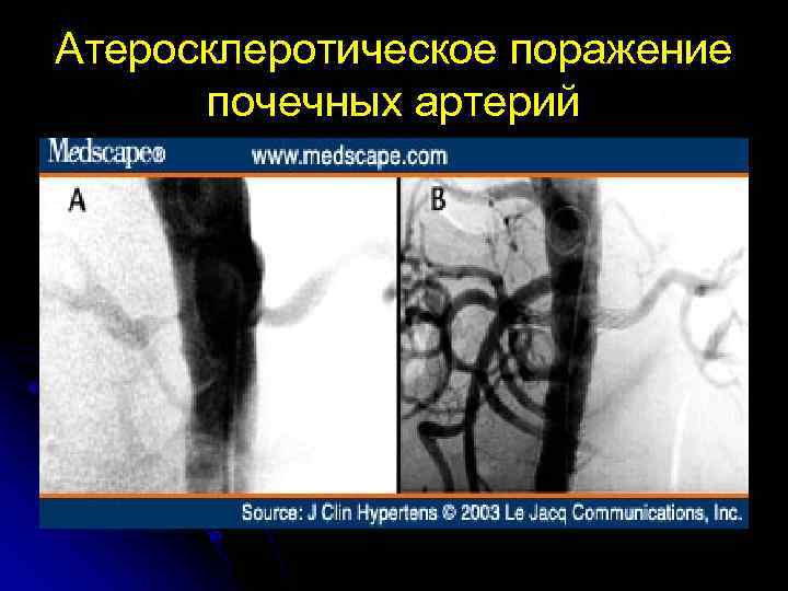 Атеросклеротическое поражение почечных артерий 