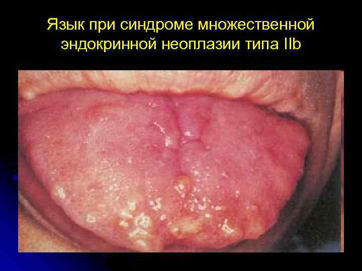 Язык при синдроме множественной эндокринной неоплазии типа IIb 