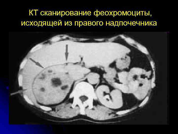 КТ сканирование феохромоциты, исходящей из правого надпочечника 