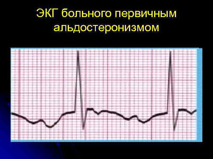 ЭКГ больного первичным альдостеронизмом 
