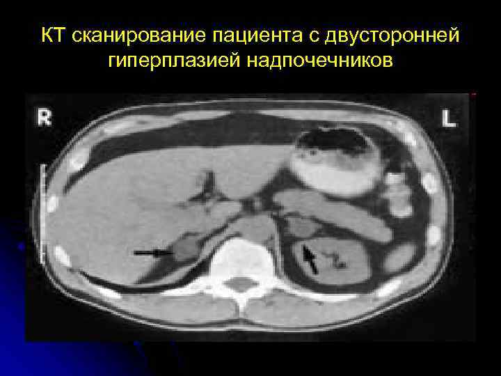 КТ сканирование пациента с двусторонней гиперплазией надпочечников 