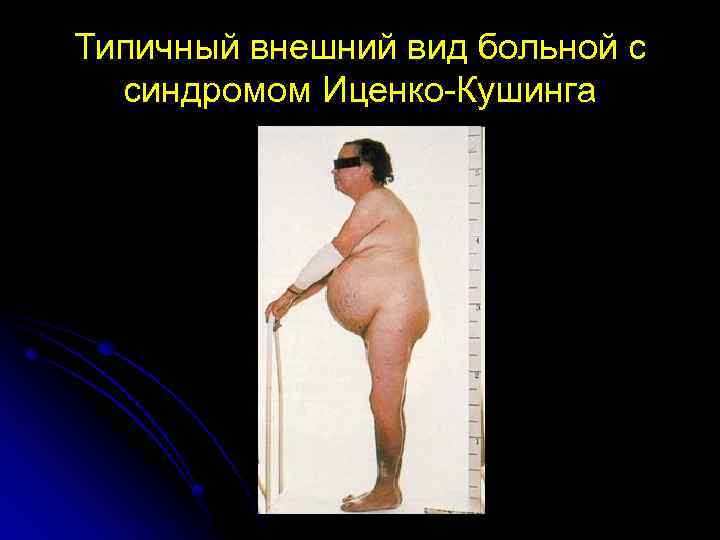 Типичный внешний вид больной с синдромом Иценко-Кушинга 