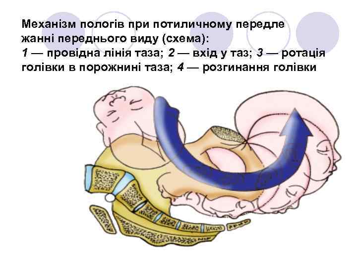 Механізм пологів при потиличному передле жанні переднього виду (схема): 1 — провідна лінія таза;