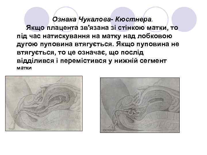 Ознака Чукалова- Кюстнера. Якщо плацента зв'язана зі стінкою матки, то під час натискування на