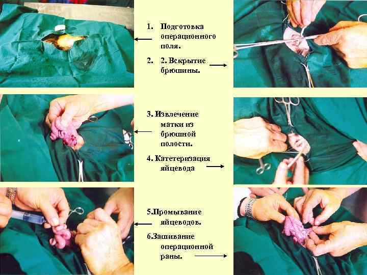 1. Подготовка операционного поля. 2. 2. Вскрытие брюшины. 3. Извлечение матки из брюшной полости.