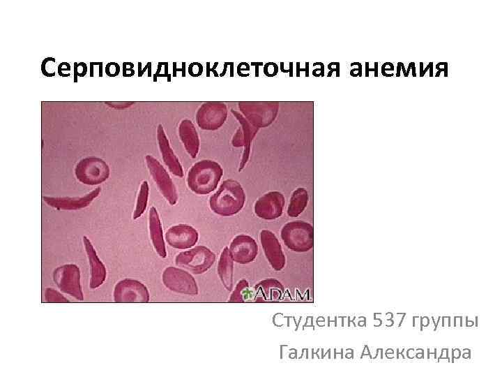 Серповидноклеточная анемия Студентка 537 группы Галкина Александра 