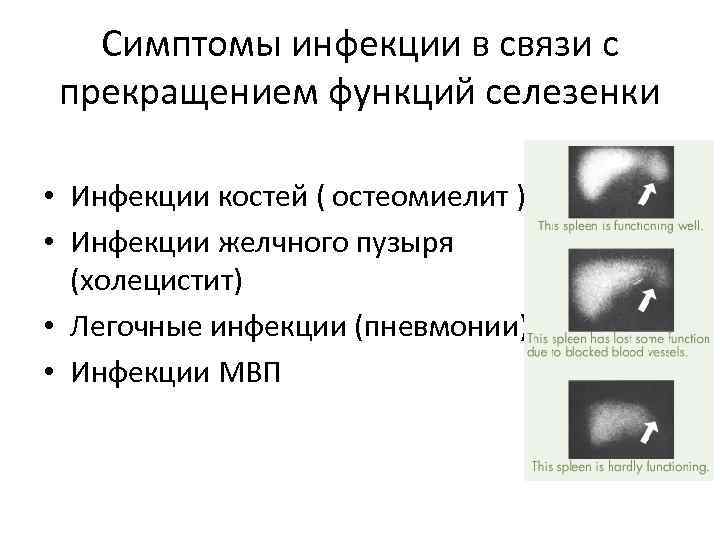 Симптомы инфекции в связи с прекращением функций селезенки • Инфекции костей ( остеомиелит )