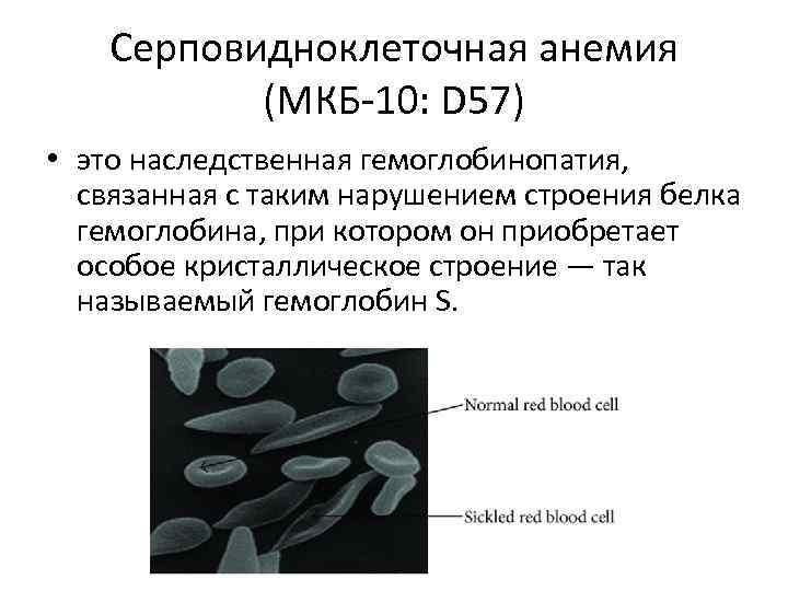 Серповидноклеточная анемия (МКБ 10: D 57) • это наследственная гемоглобинопатия, связанная с таким нарушением