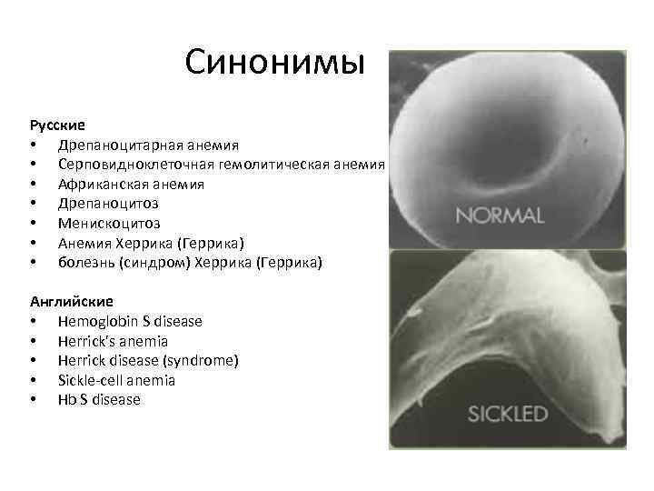 Синонимы Русские • Дрепаноцитарная анемия • Серповидноклеточная гемолитическая анемия • Африканская анемия • Дрепаноцитоз