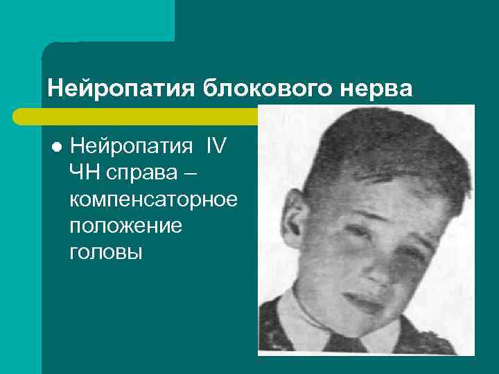Нейропатия блокового нерва l Нейропатия IV ЧН справа – компенсаторное положение головы 
