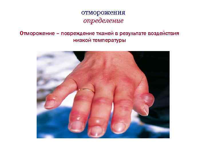отморожения определение Отморожение – повреждение тканей в результате воздействия низкой температуры 
