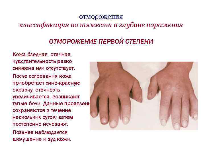 отморожения классификация по тяжести и глубине поражения ОТМОРОЖЕНИЕ ПЕРВОЙ СТЕПЕНИ Кожа бледная, отечная, чувствительность