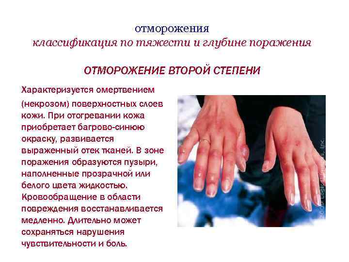 отморожения классификация по тяжести и глубине поражения ОТМОРОЖЕНИЕ ВТОРОЙ СТЕПЕНИ Характеризуется омертвением (некрозом) поверхностных