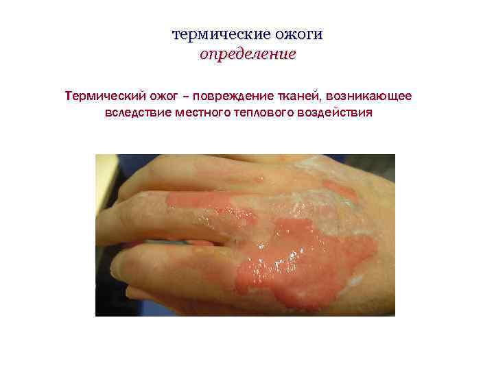 термические ожоги определение Термический ожог – повреждение тканей, возникающее вследствие местного теплового воздействия 