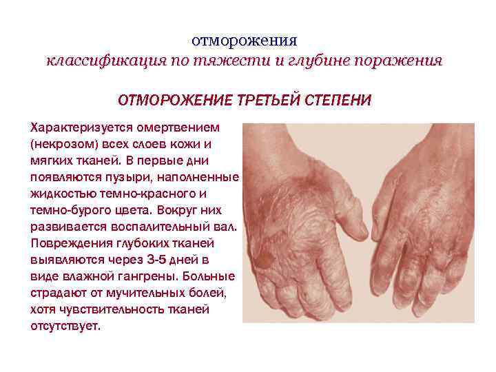 отморожения классификация по тяжести и глубине поражения ОТМОРОЖЕНИЕ ТРЕТЬЕЙ СТЕПЕНИ Характеризуется омертвением (некрозом) всех