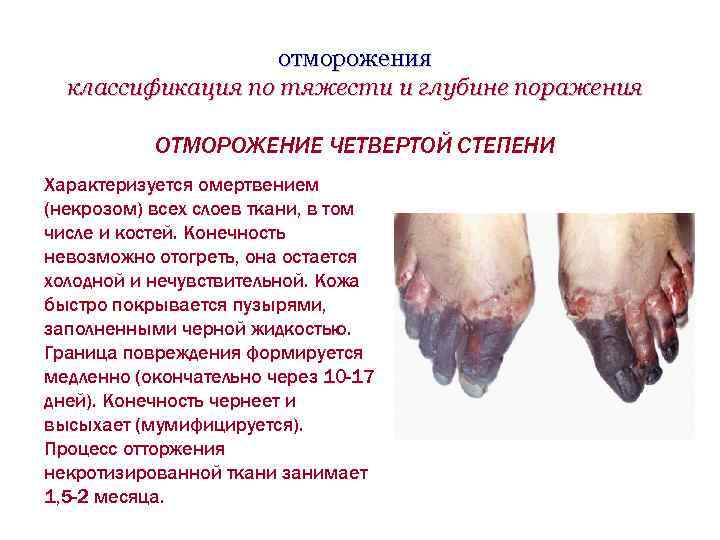 отморожения классификация по тяжести и глубине поражения ОТМОРОЖЕНИЕ ЧЕТВЕРТОЙ СТЕПЕНИ Характеризуется омертвением (некрозом) всех