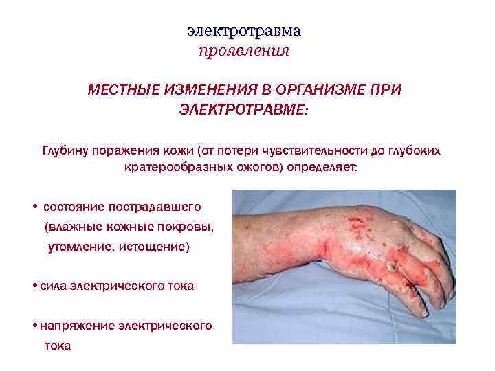 электротравма проявления МЕСТНЫЕ ИЗМЕНЕНИЯ В ОРГАНИЗМЕ ПРИ ЭЛЕКТРОТРАВМЕ: Глубину поражения кожи (от потери чувствительности