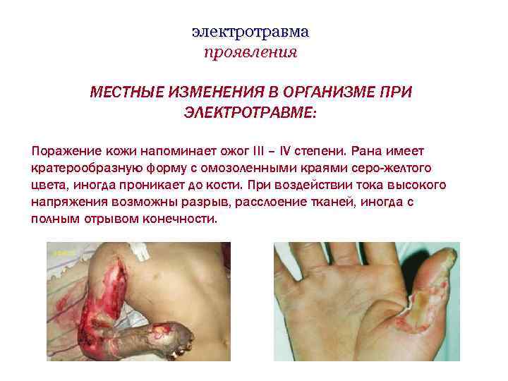 электротравма проявления МЕСТНЫЕ ИЗМЕНЕНИЯ В ОРГАНИЗМЕ ПРИ ЭЛЕКТРОТРАВМЕ: Поражение кожи напоминает ожог III –