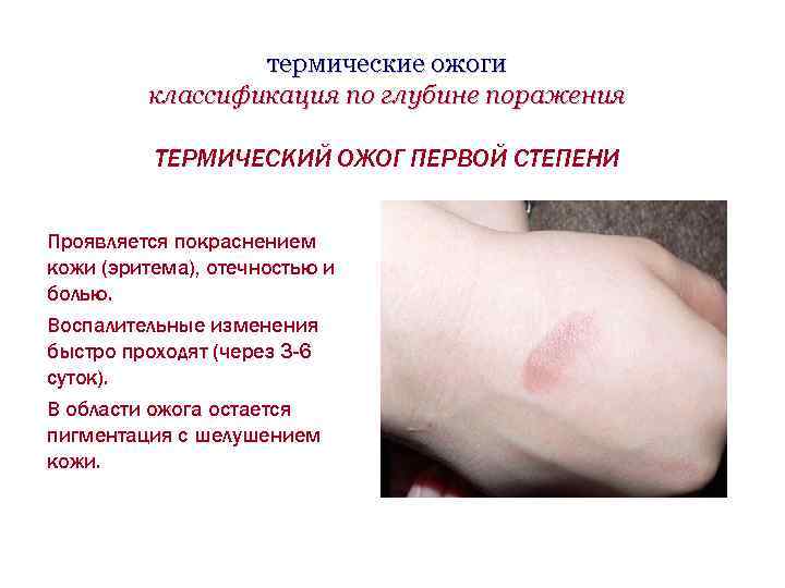 термические ожоги классификация по глубине поражения ТЕРМИЧЕСКИЙ ОЖОГ ПЕРВОЙ СТЕПЕНИ Проявляется покраснением кожи (эритема),