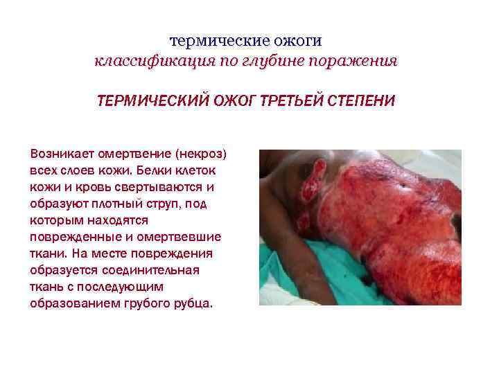 термические ожоги классификация по глубине поражения ТЕРМИЧЕСКИЙ ОЖОГ ТРЕТЬЕЙ СТЕПЕНИ Возникает омертвение (некроз) всех