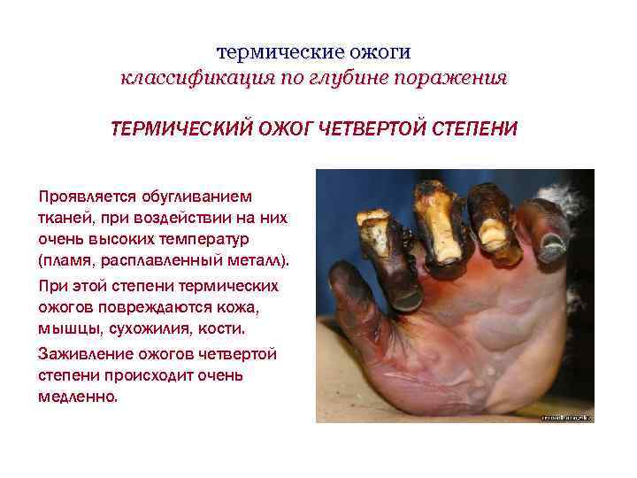 термические ожоги классификация по глубине поражения ТЕРМИЧЕСКИЙ ОЖОГ ЧЕТВЕРТОЙ СТЕПЕНИ Проявляется обугливанием тканей, при