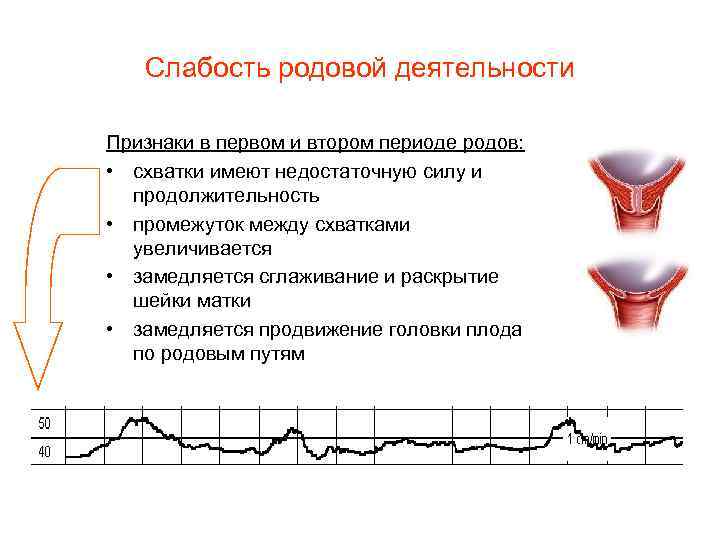 Слабость родовой деятельности Признаки в первом и втором периоде родов: • схватки имеют недостаточную