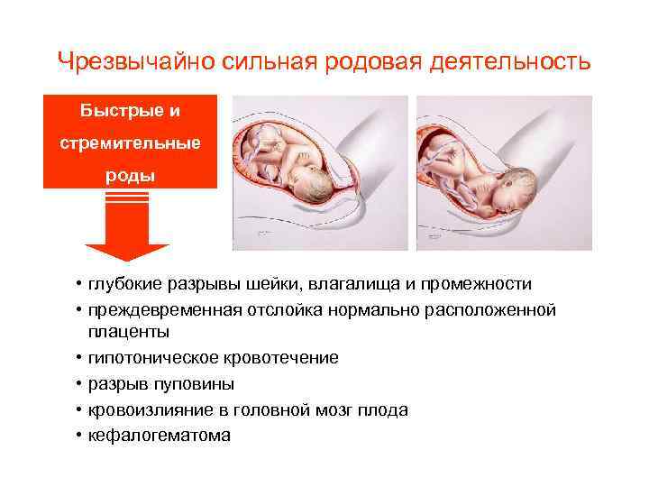 Чрезвычайно сильная родовая деятельность Быстрые и стремительные роды • глубокие разрывы шейки, влагалища и