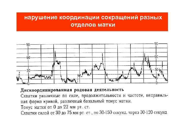 нарушение координации сокращений разных отделов матки 