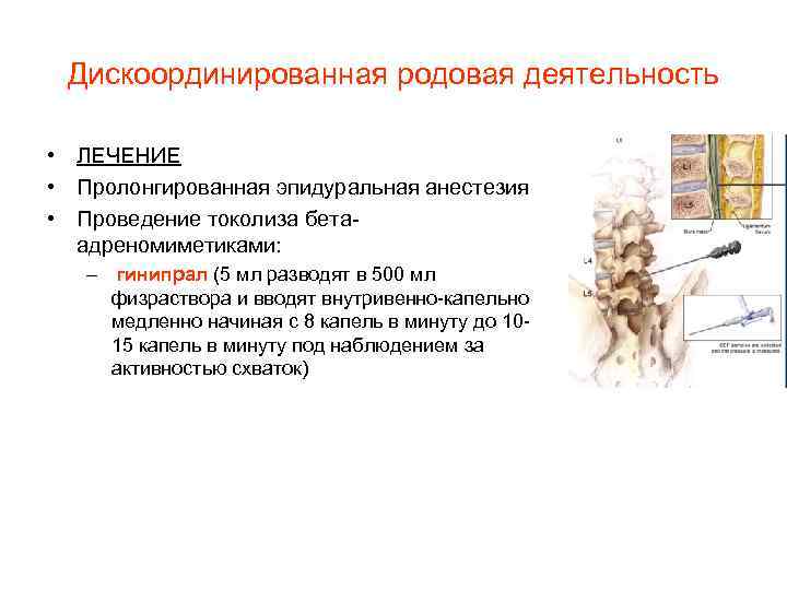 Дискоординированная родовая деятельность • ЛЕЧЕНИЕ • Пролонгированная эпидуральная анестезия • Проведение токолиза бетаадреномиметиками: –