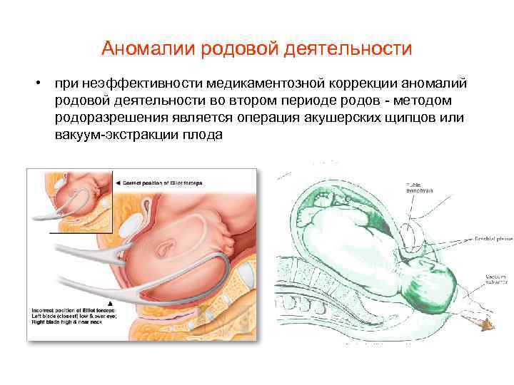 Аномалии родовой деятельности • при неэффективности медикаментозной коррекции аномалий родовой деятельности во втором периоде