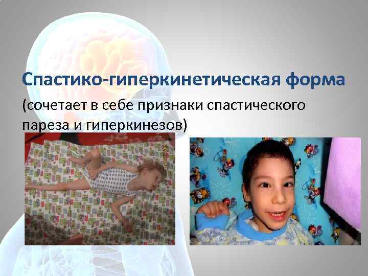 Спастико-гиперкинетическая форма (сочетает в себе признаки спастического пареза и гиперкинезов) 