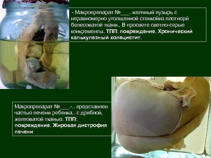 - Макропрепарат №___. желчный пузырь с неравномерно утолщенной стенкойиз плотнорй белесоватой ткани. , В